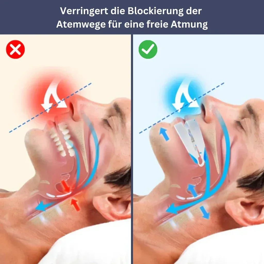 SilentNight – Anti-Snoring & Protrusion Guard