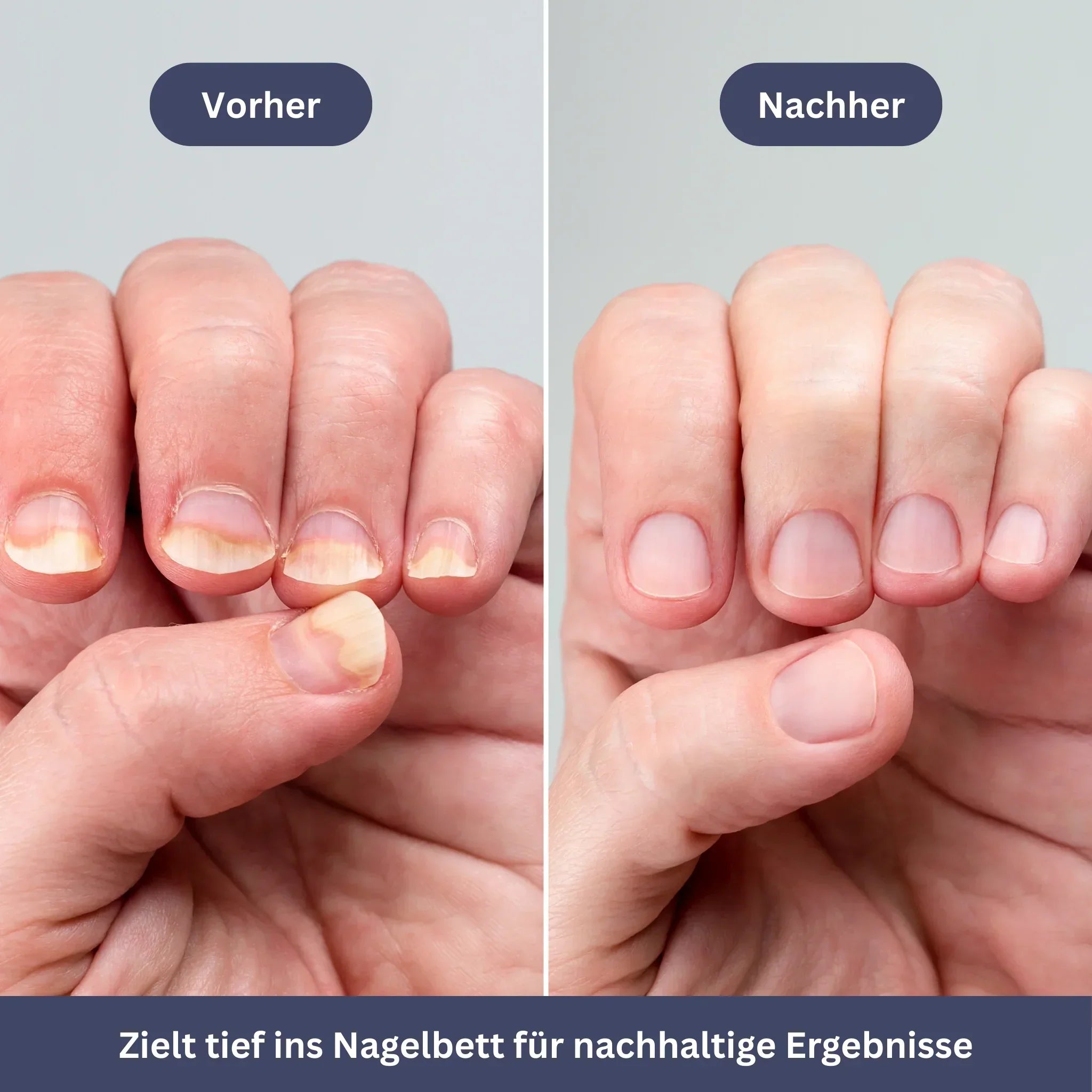 NailPen – Repair Pen for Nail Fungus & Inflammation